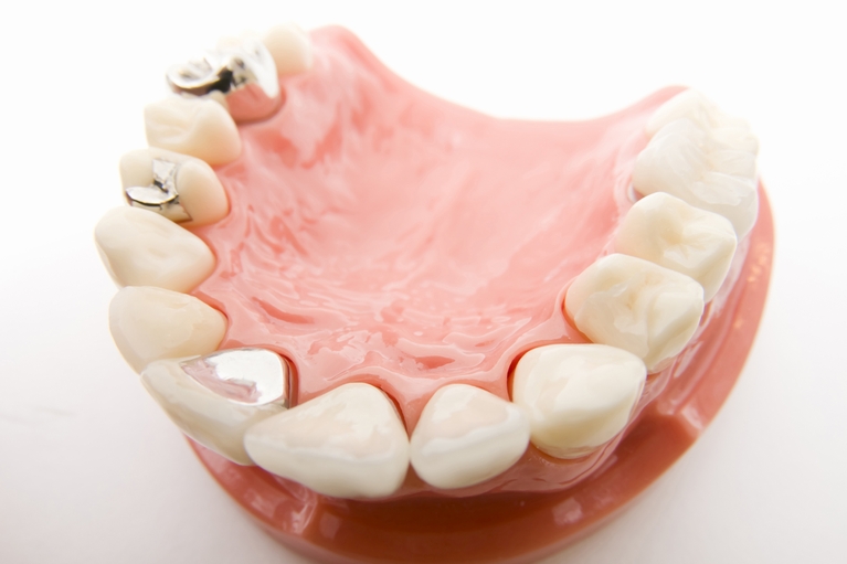 虫歯治療で歯を失ってしまう仕組み